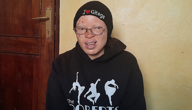 Albinism Community in Kayanza Seeks Protection Amidst Discrimination and Health Challenges